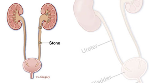 Kidney Stones Treatment Gramercy Park