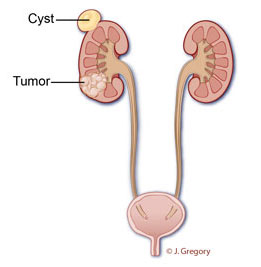 Kidney Cancer Care in Throgs Neck